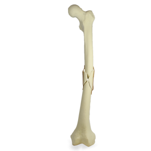 FÊMUR COM FRATURA COMINUTIVA - ESQUERDO - cód. 9703